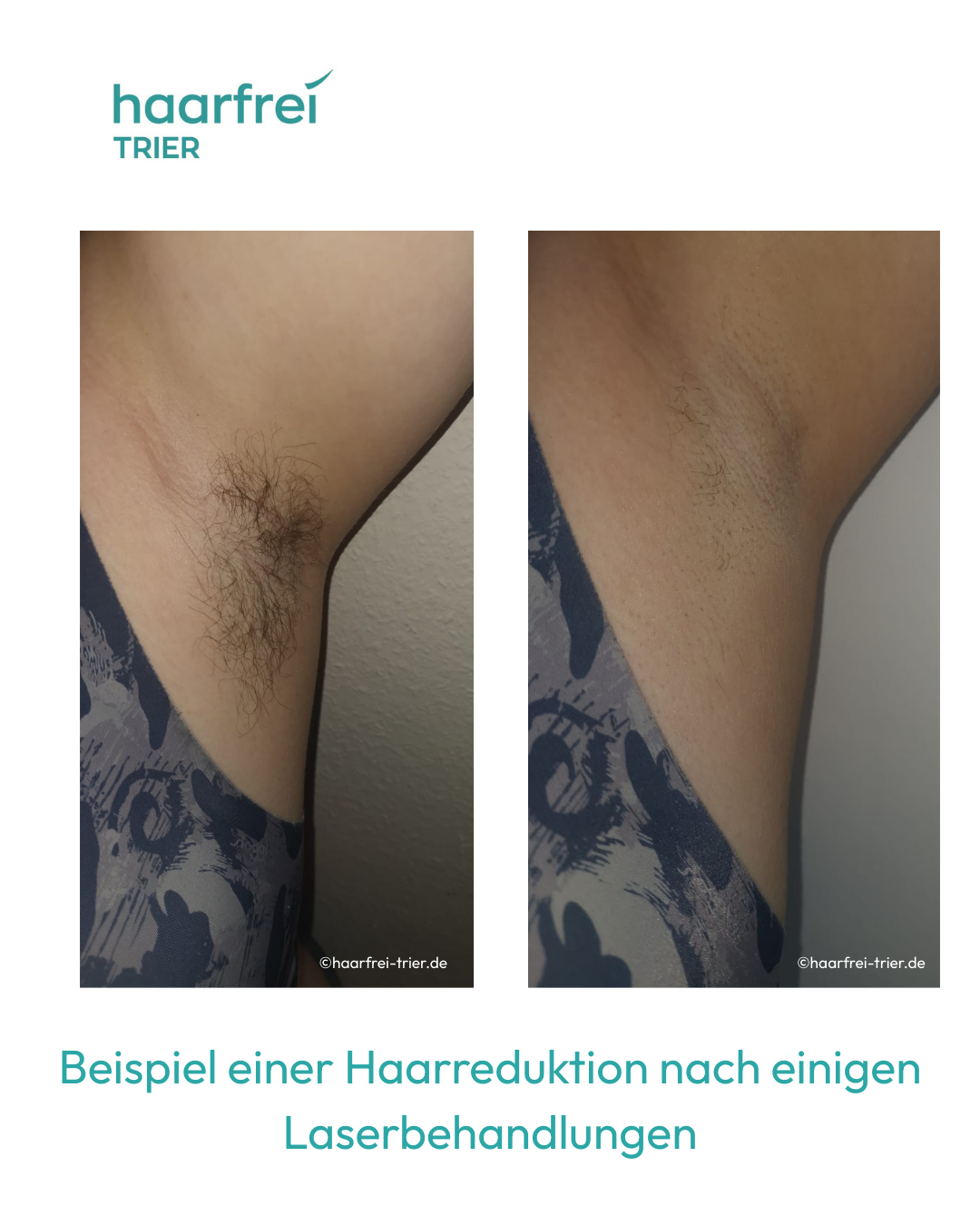 Laser Haarentfernung Achseln Trier – Vorher Nachher