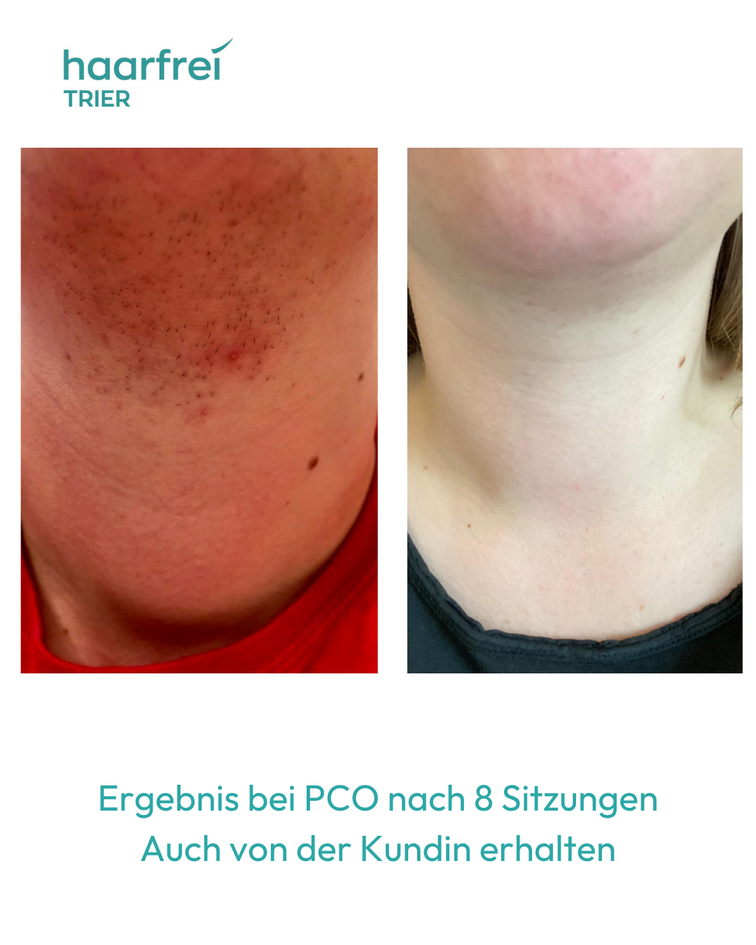 Haarentfernung Hals PCO-Behaarung Trier – nach 8 Sitzungen